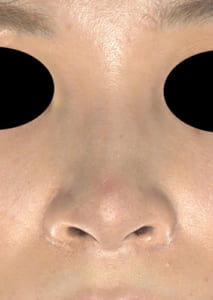 鼻孔縁延長⑦正面術後