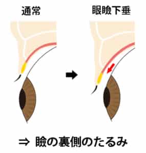 眼瞼下垂（瞼の裏のたるみ）