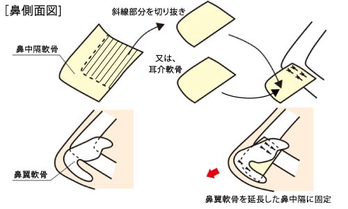 鼻中隔延長の効果とリスク、ダウンタイムについて　鼻中隔延長手術解説図