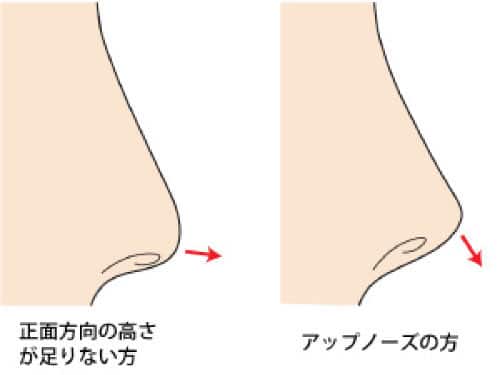 鼻尖縮小をおこなわずに軟骨移植だけおこなうことはできる？　鼻先軟骨移植方向