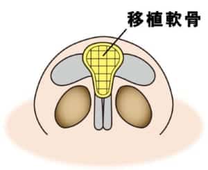 鼻尖軟骨移植のイメージ