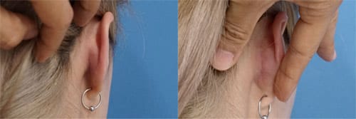 鼻の整形、耳介軟骨移植って？耳介軟骨移植の効果とリスク・失敗について　耳の後ろの傷
