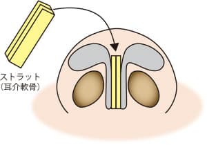 鼻の整形、耳介軟骨移植って？耳介軟骨移植の効果とリスク・失敗について　鼻尖軟骨移植（ストラット）２