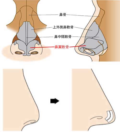 鼻尖縮小をおこなわずに軟骨移植だけおこなうことはできる？　鼻翼軟骨図