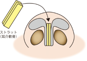 鼻尖軟骨移植（ストラット）