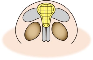 鼻の整形、耳介軟骨移植って？耳介軟骨移植の効果とリスク・失敗について　鼻尖軟骨移植アルマジロ