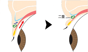 二重術の構造（断面図）