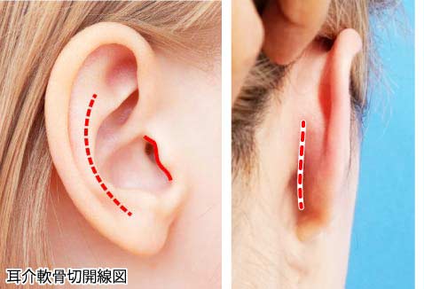 耳介軟骨移植はどこから軟骨を採取する？耳の傷は目立たない？　軟骨採取切開線ー１