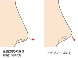 軟骨を移植する方向