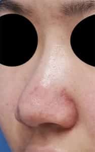 鼻尖縮小、鼻翼縮小（内側＋外側）手術前左斜め