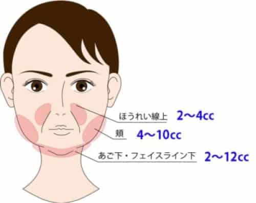 デオキシコール酸系　小顔脂肪溶解注射注入部位　注入量