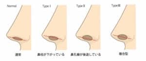 鼻の穴が横から見えやすいタイプ