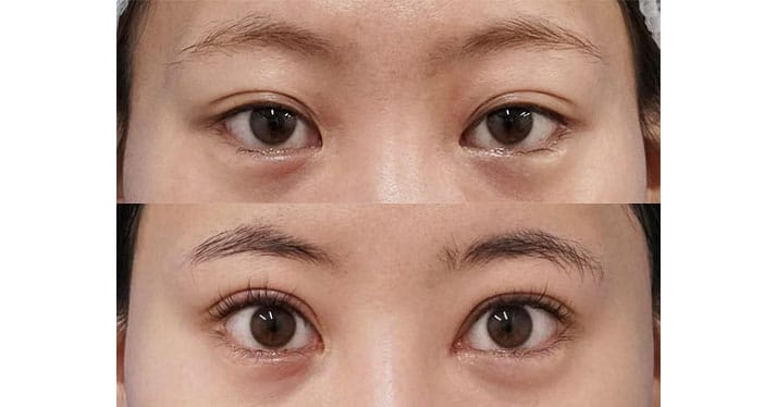 目力を出して目を明るくしたい。二重全切開＋挙筋前転術（眼瞼下垂）、目頭切開他院修正（Z形成Park法）　６か月後