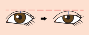 眼瞼下垂、二重広くなる