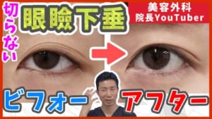 切らない眼瞼下垂のビフォーアフターのサムネイル