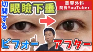 切開する眼瞼下垂のビフォーアフターを症例写真付きで解説