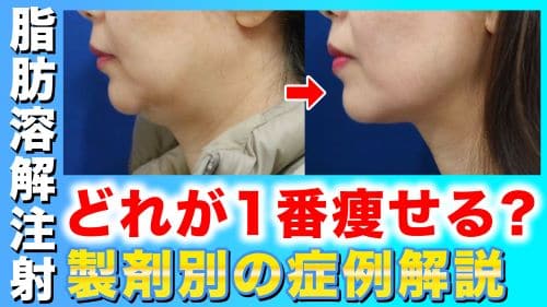 顔の脂肪溶解注射って効果あるの？症例写真付きで解説！