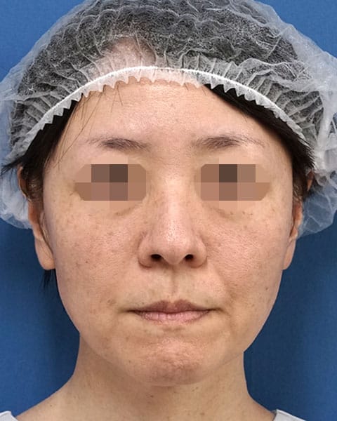 人中短縮術　３か月後のBefore写真