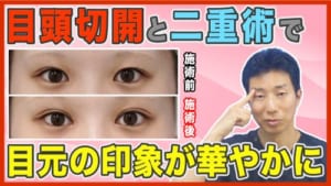 切開と二重整形(埋没法や全切開)を併用するメリットや適応を徹底解説のサムネイル