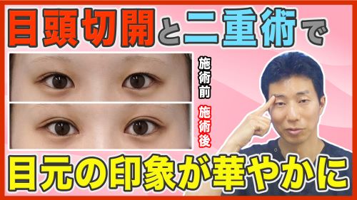 目頭切開と二重整形を併用すると、目元の印象はどう変わるかを症例写真を用いて徹底解説