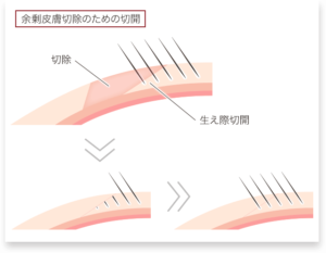 毛包斜切開