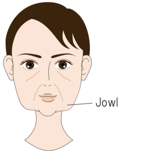 Jowlのたるみ