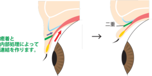 二重全切開の構造（断面図）