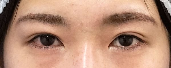 目頭切開（Z形成）＋眉下切開 ６ヶ月後、切らない眼瞼下垂プレミアム １年後、のBefore写真