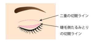 睫毛側たるみとりの切除部分イメージ