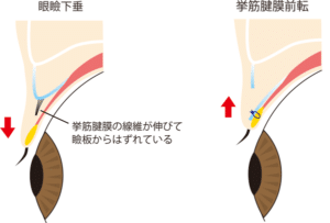 挙筋前転術イメージ