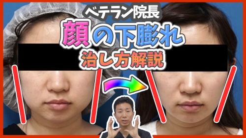 【小顔整形】下膨れ顔を整形やプチ整形で治す全ての方法を徹底解説