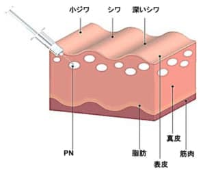 リジュラン注入層